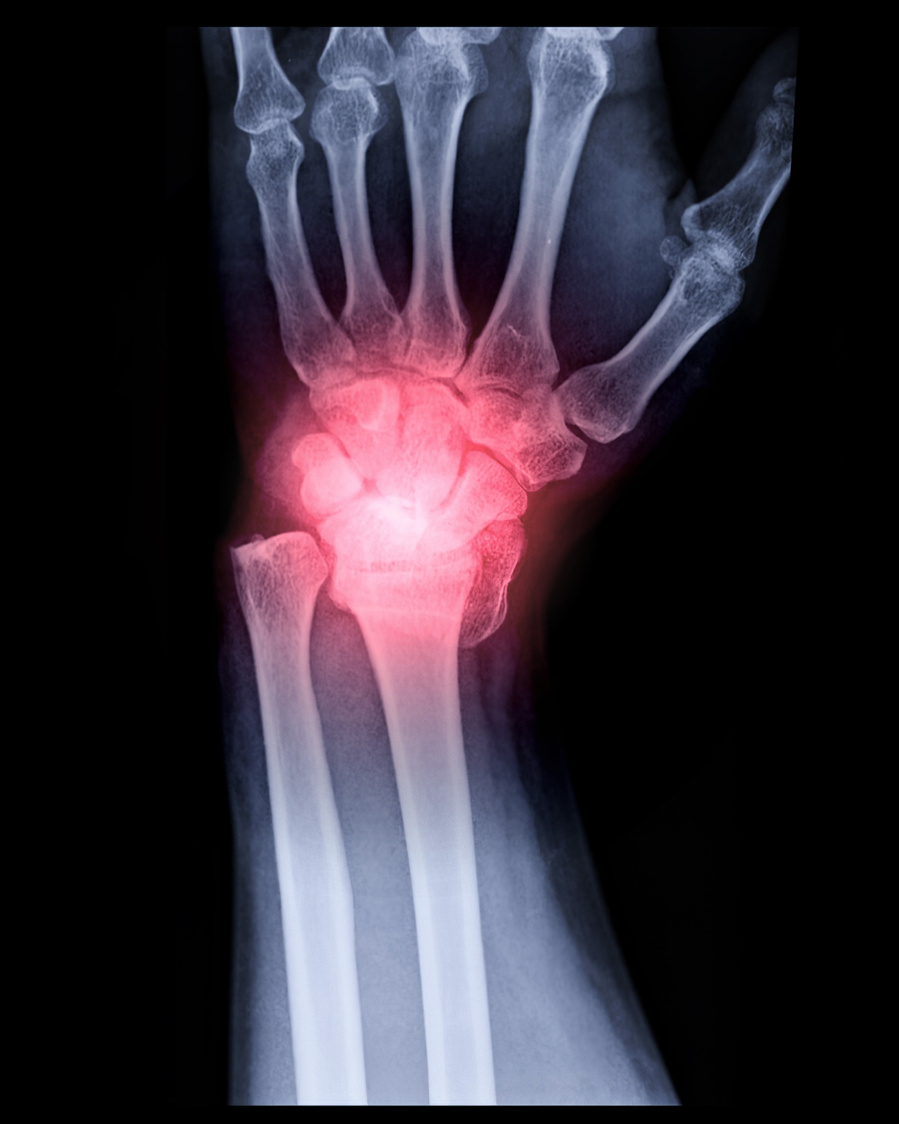 Compensation Calculator For A Wrist Fracture That Has Been Missed ...