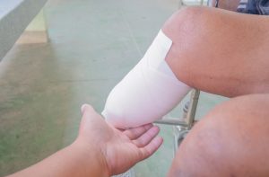 Bandages wrapped around someone's leg stump following an amputation.