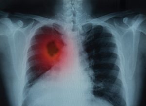 An X-ray of a patients lungs that shows lung cancer.