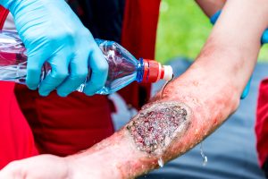 A medical worker treats a serious burn injury.