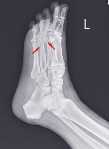 X-RAY LOOKING FOR ANKLE INJURIES