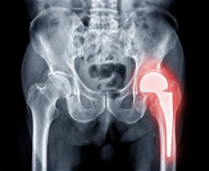 An X-ray image of a pelvis with the top of the left femur bone highlighted in red.