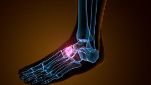 X-Ray image of a ruptured tendon on the top of a foot 